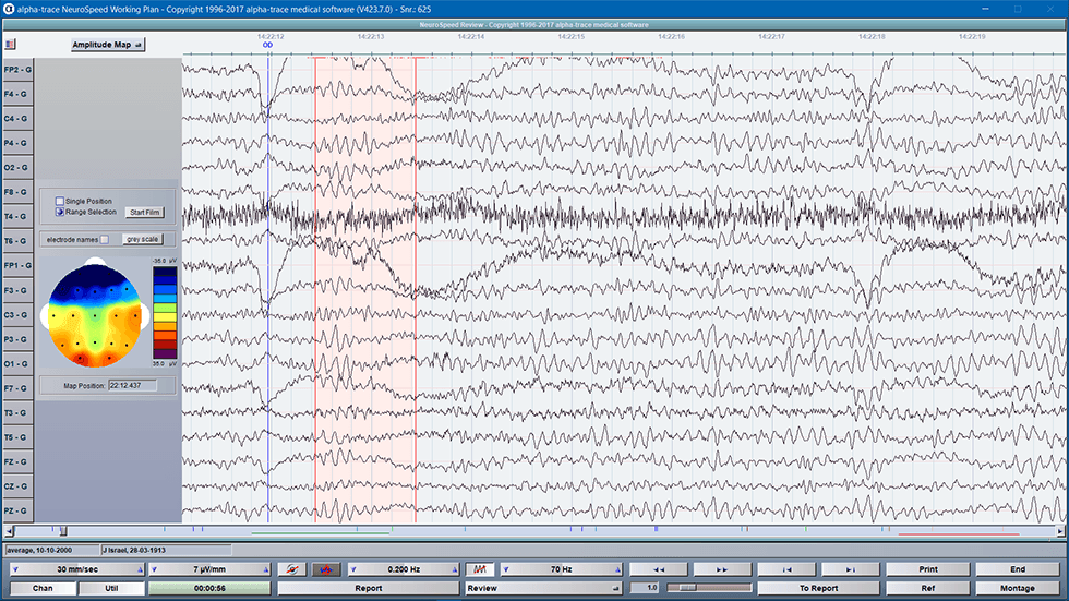 Quantitatief EEG