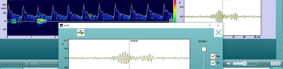 Embolie Detectie Software