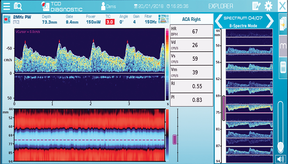 Doppler, M-Mode, 9 dieptes