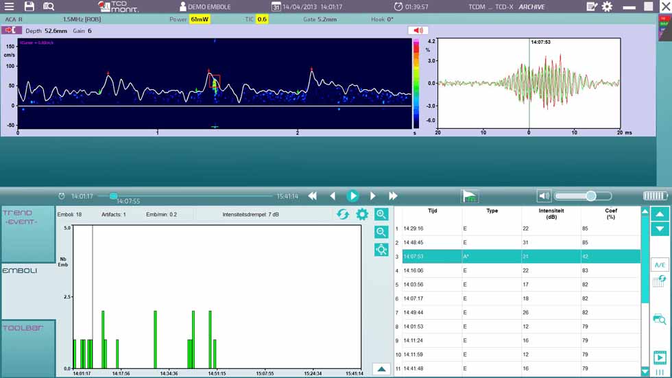 Micro Embolie Detectie Software